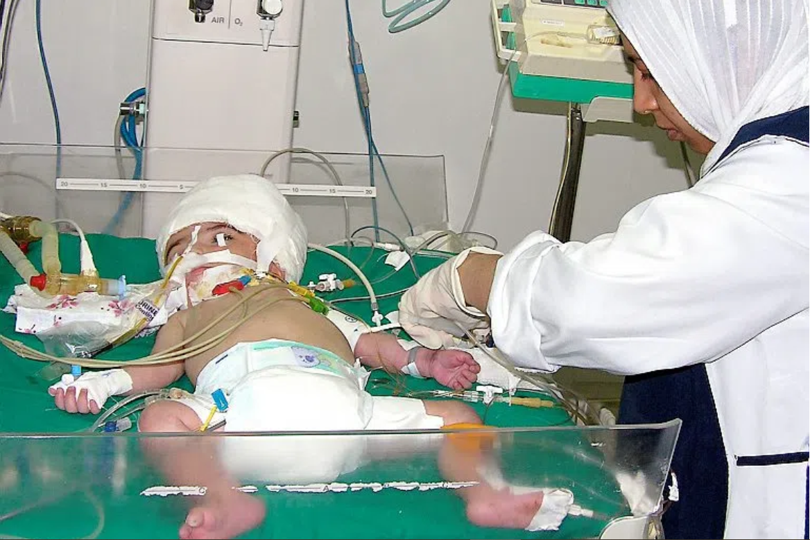 B&eacute; g&aacute;i sinh ra với 2 khu&ocirc;n mặt tr&ecirc;n c&ugrave;ng một đầu, ca y khoa &aacute;m ảnh nhất lịch sử - Ảnh 2.