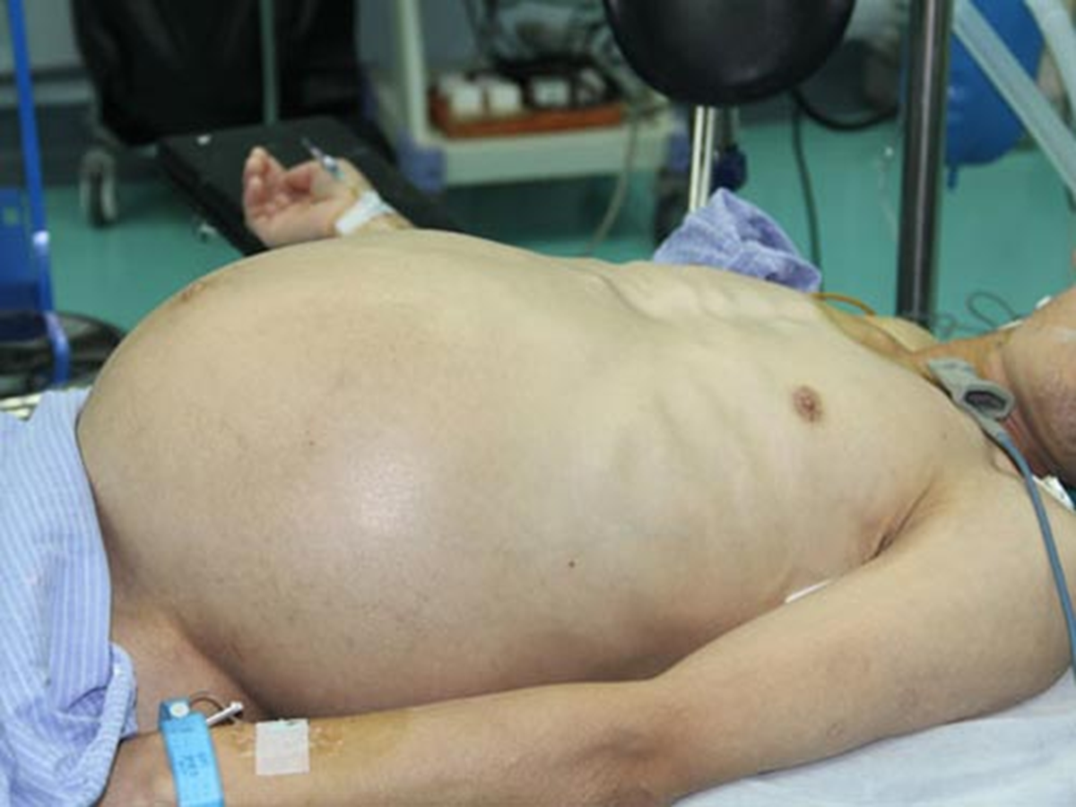 Người đ&agrave;n &ocirc;ng bụng ph&igrave;nh to như "mang thai", b&aacute;c sĩ lấy ra thứ "đ&aacute;ng sợ" nặng 20kg - Ảnh 1.