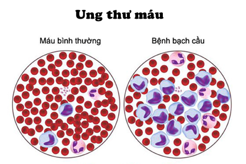 TikToker Đan Thy th&ocirc;ng b&aacute;o mắc ung thư m&aacute;u ở tuổi 23: Ung thư m&aacute;u c&oacute; chữa được kh&ocirc;ng?- Ảnh 3.