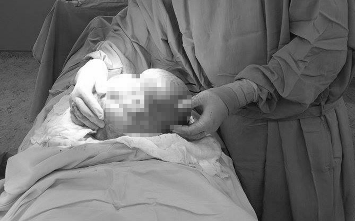 B&eacute; 10 ng&agrave;y tuổi bụng chướng căng, b&aacute;c sĩ ph&aacute;t hiện thứ "đ&aacute;ng sợ" to như quả trứng ẩn b&ecirc;n trong - Ảnh 3.