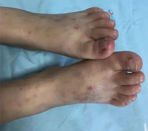 B&eacute; g&aacute;i lớp 5 đ&atilde; mắc bệnh g&uacute;t, b&aacute;c sĩ n&oacute;i thẳng: 5 m&oacute;n vạn người m&ecirc; n&agrave;y l&agrave; "đồng phạm" - Ảnh 1.