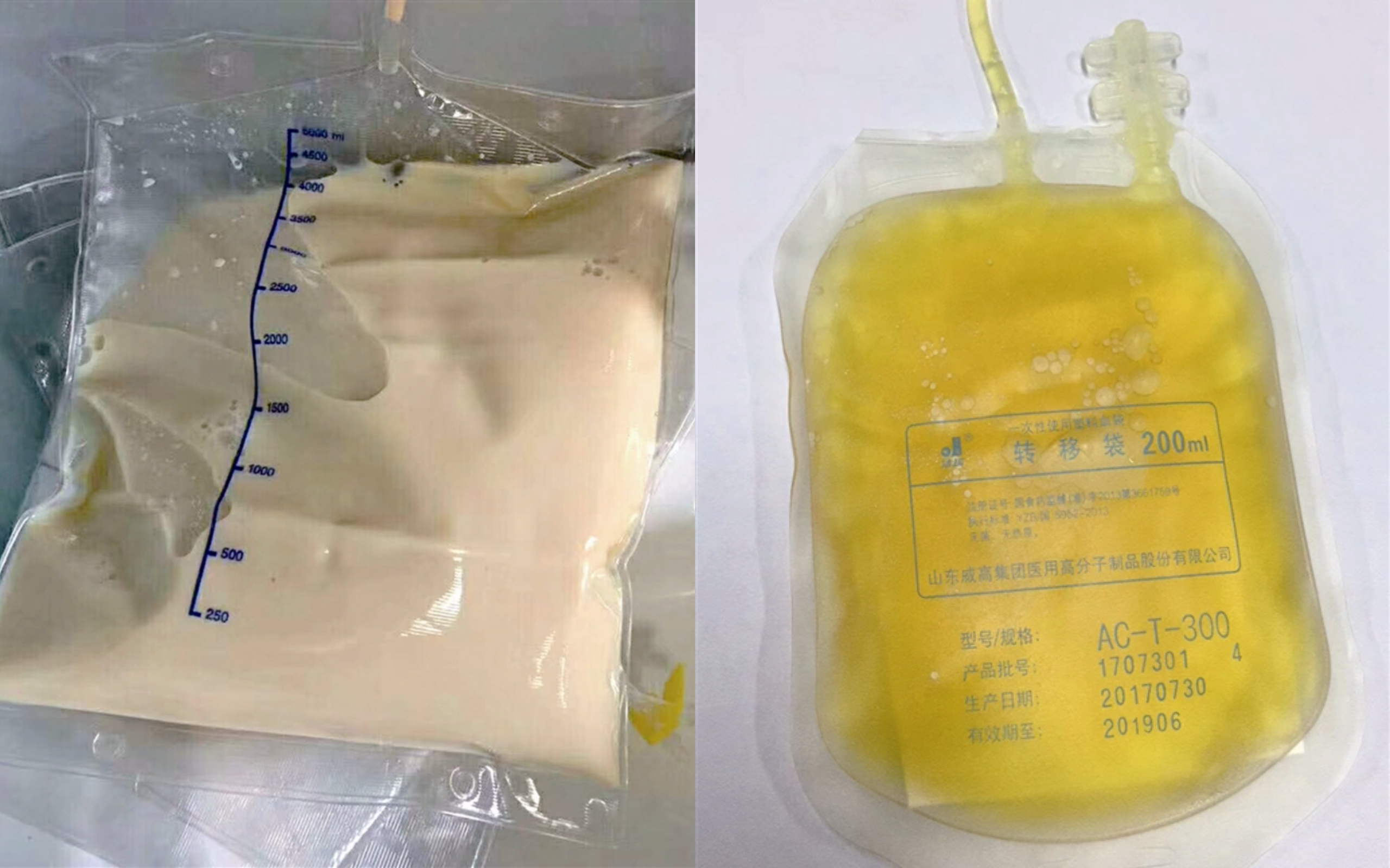Thiếu nữ 20 tuổi gan nhiễm mỡ nặng sau khi giảm 12kg trong 1 th&aacute;ng: "T&ocirc;i chỉ ăn 1 thứ mỗi bữa" - Ảnh 2.