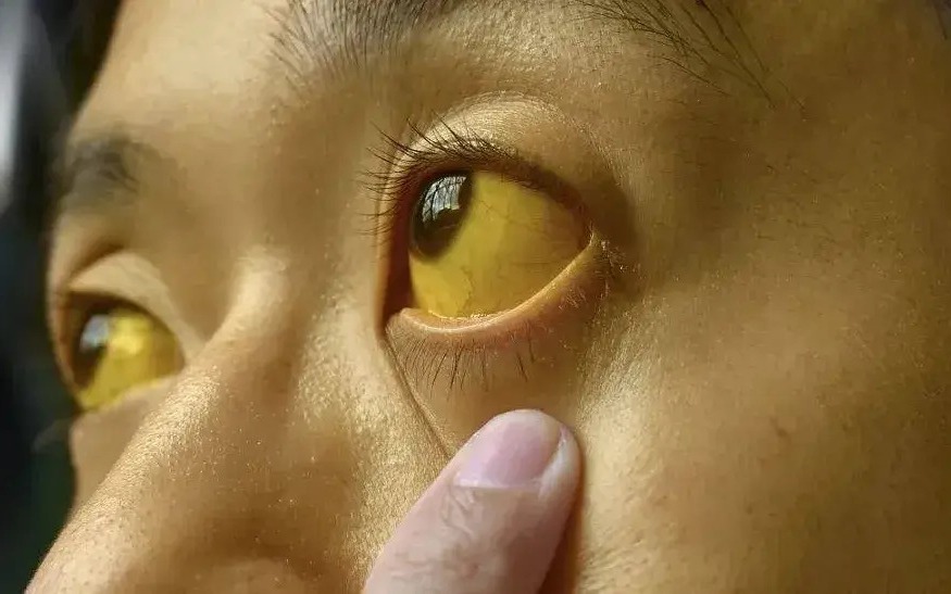 Bỏ qua dấu hiệu "lạ" suốt 1 năm, người đ&agrave;n &ocirc;ng 50 tuổi sốc khi biết mắc ung thư - Ảnh 3.
