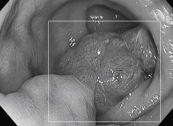 Bỏ qua dấu hiệu "lạ" suốt 1 năm, người đ&agrave;n &ocirc;ng 50 tuổi sốc khi biết mắc ung thư - Ảnh 1.