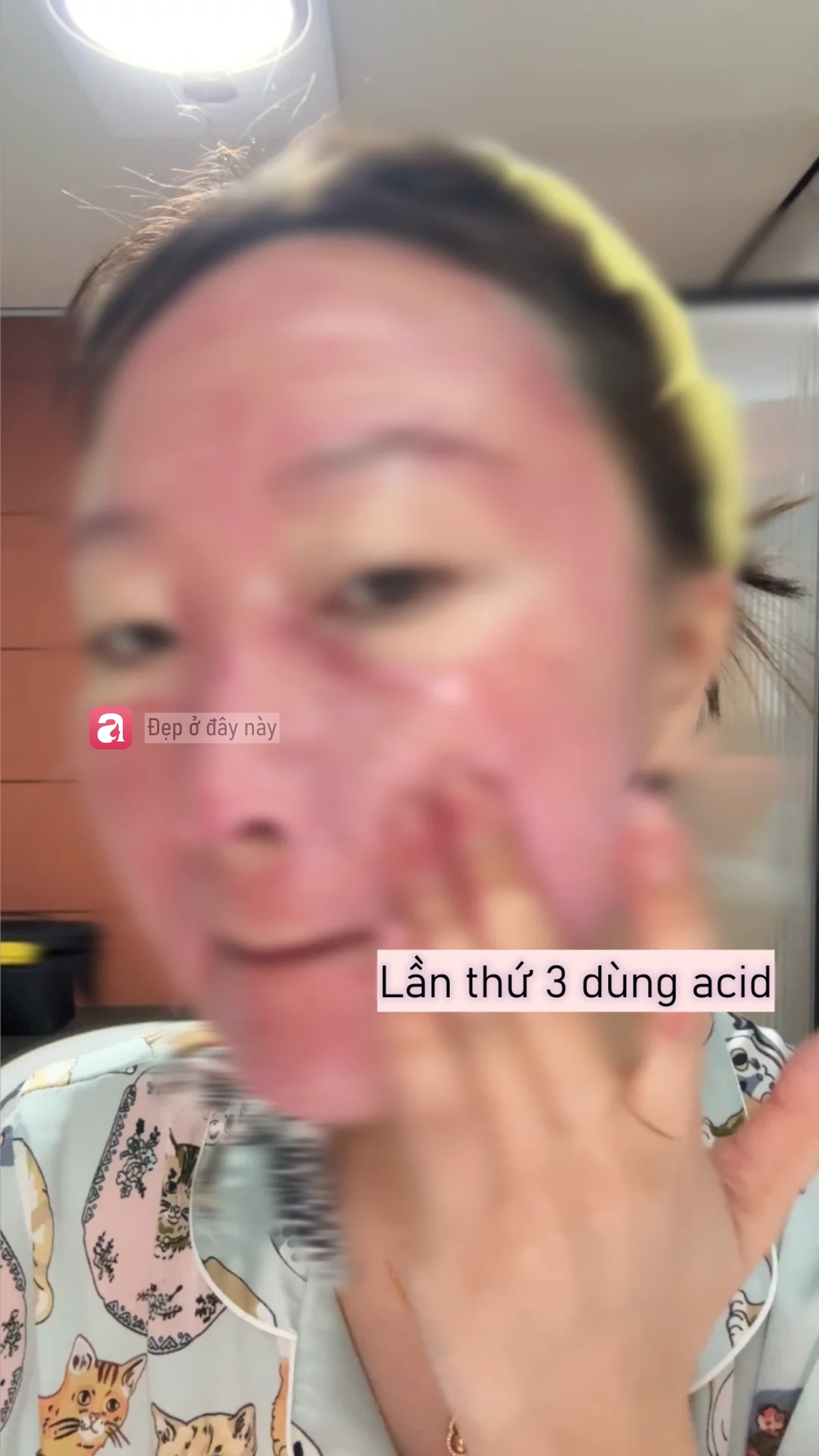 Da b&oacute;ng v&agrave; l&aacute;ng căng sau 3 ph&uacute;t d&ugrave;ng acid nồng độ 30%, nhưng sự thật kh&ocirc;ng đơn giản như t&ocirc;i nghĩ - Ảnh 2.