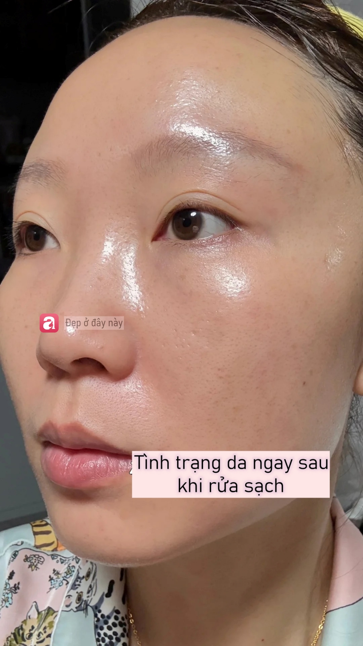 Da b&oacute;ng v&agrave; l&aacute;ng căng sau 3 ph&uacute;t d&ugrave;ng acid nồng độ 30%, nhưng sự thật kh&ocirc;ng đơn giản như t&ocirc;i nghĩ - Ảnh 3.