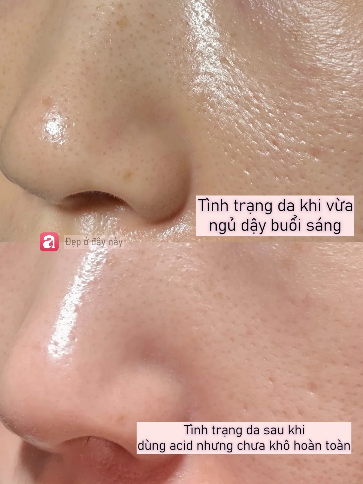 Da b&oacute;ng v&agrave; l&aacute;ng căng sau 3 ph&uacute;t d&ugrave;ng acid nồng độ 30%, nhưng sự thật kh&ocirc;ng đơn giản như t&ocirc;i nghĩ - Ảnh 6.