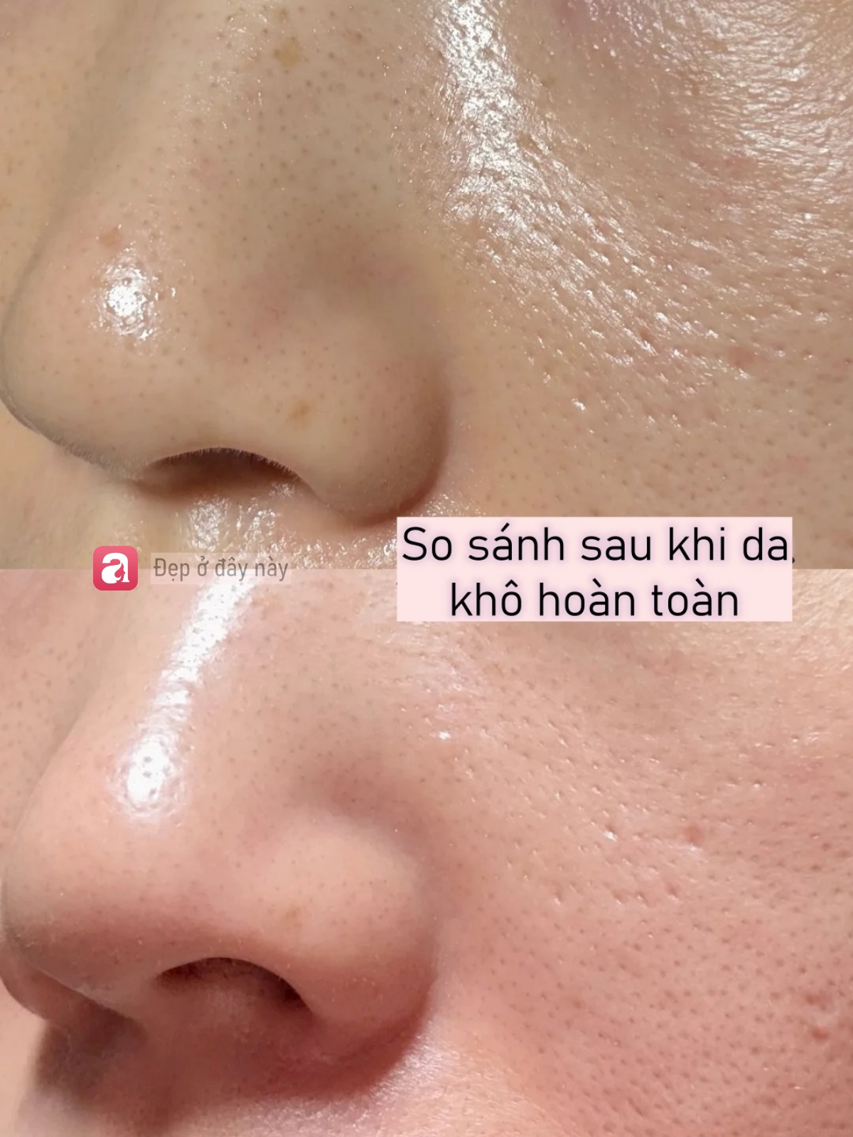 Da b&oacute;ng v&agrave; l&aacute;ng căng sau 3 ph&uacute;t d&ugrave;ng acid nồng độ 30%, nhưng sự thật kh&ocirc;ng đơn giản như t&ocirc;i nghĩ - Ảnh 5.