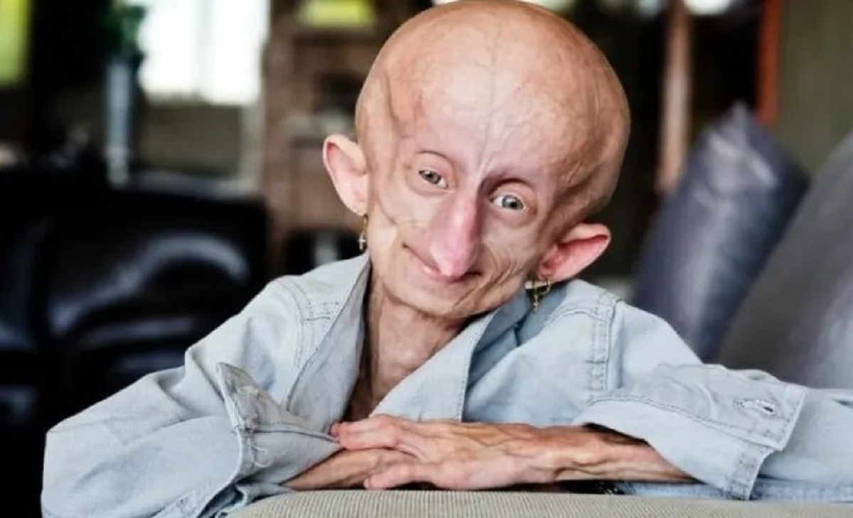 Bi kịch c&ocirc; g&aacute;i 19 tuổi với gương mặt như 90 tuổi: Số phận khiến nhiều người nghẹn ng&agrave;o - Ảnh 1.