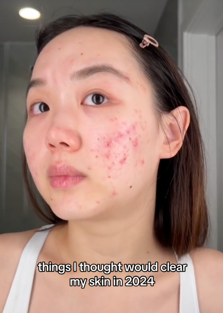 Để cứu l&agrave;n da chi ch&iacute;t mụn, c&ocirc; n&agrave;ng H&agrave;n Quốc uống loại nước &eacute;p đẹp da uống 2 lần/tuần, kết quả da đẹp ngo&agrave;i sức tưởng tượng- Ảnh 1.