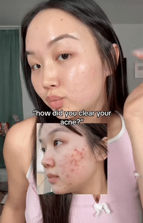 Để cứu l&agrave;n da chi ch&iacute;t mụn, c&ocirc; n&agrave;ng H&agrave;n Quốc uống loại nước &eacute;p đẹp da uống 2 lần/tuần, kết quả da đẹp ngo&agrave;i sức tưởng tượng- Ảnh 9.