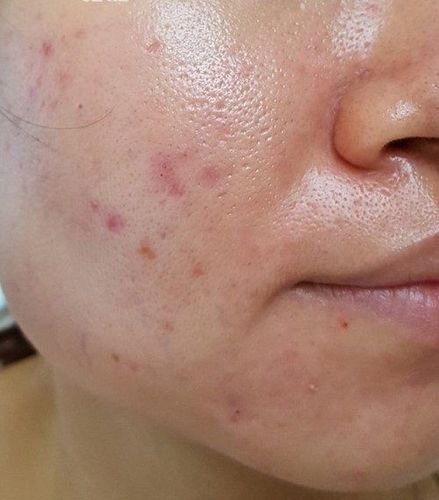 Thay v&igrave; đổi sữa rửa mặt, t&ocirc;i học c&aacute;ch rửa mặt từ b&aacute;c sĩ da liễu H&agrave;n Quốc gi&uacute;p da giảm dầu nhờn, l&aacute;ng mịn trong m&ugrave;a h&egrave;- Ảnh 1.