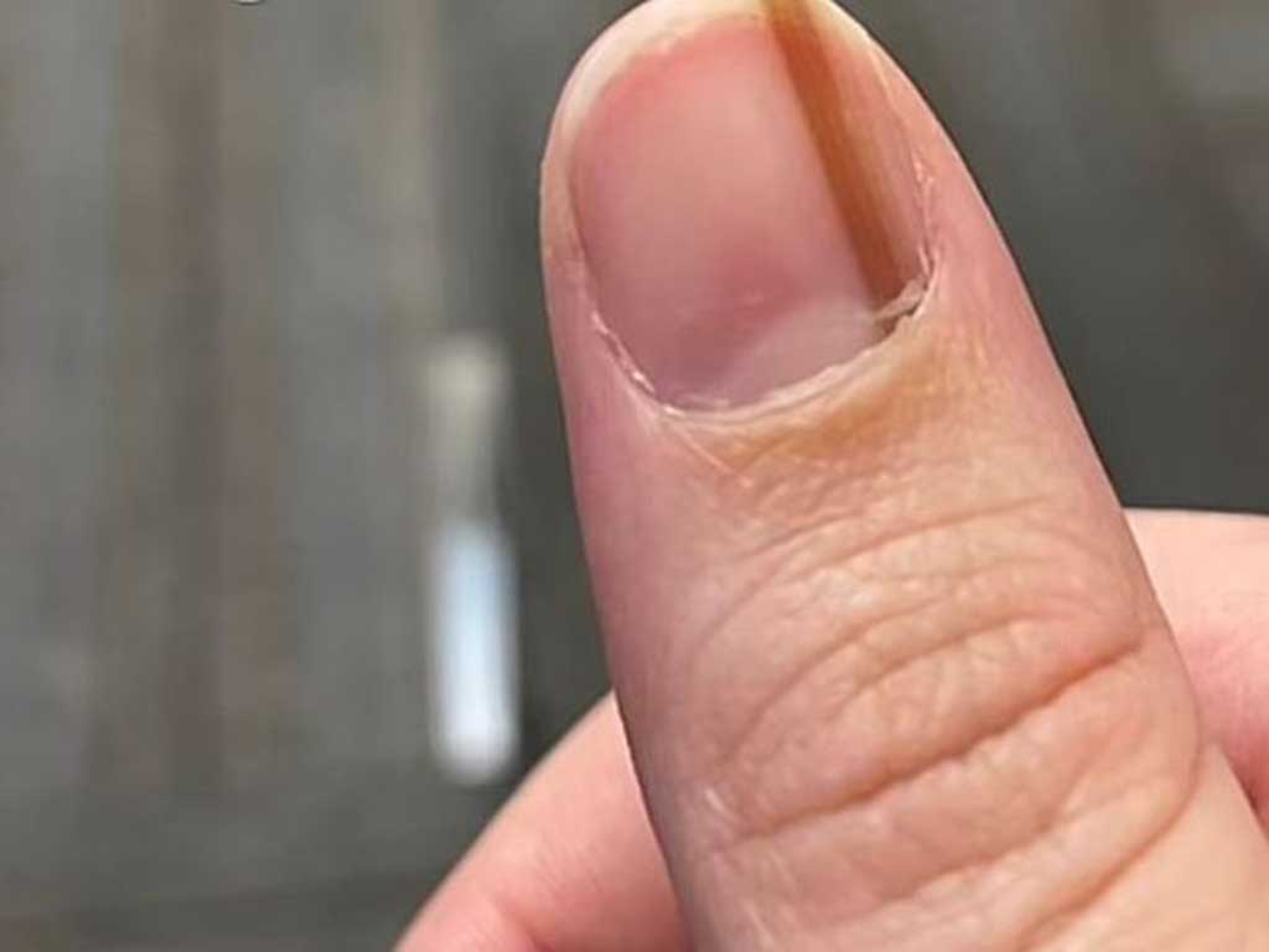 6 bất thường tr&ecirc;n m&oacute;ng tay c&oacute; thể đang &ldquo;tố c&aacute;o&rdquo; bệnh trong cơ thể bạn - Ảnh 2.