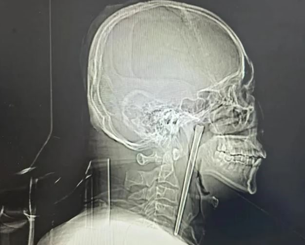 Đau nh&oacute;i mắt tr&aacute;i, người đ&agrave;n &ocirc;ng 50 tuổi sốc nặng khi b&aacute;c sĩ gắp ra thứ "đ&aacute;ng sợ" d&agrave;i 12cm - Ảnh 2.