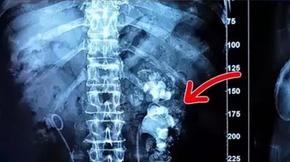 Uống loại nước "vạn người m&ecirc;", c&ocirc; g&aacute;i "sốc" khi ph&aacute;t hiện sỏi thận "phủ k&iacute;n" hai b&ecirc;n thận - Ảnh 1.
