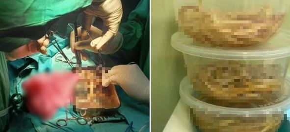 B&eacute; trai 3 tuổi n&ocirc;n ra giun, khi phẫu thuật b&aacute;c sĩ ph&aacute;t hiện điều đ&aacute;ng sợ hơn- Ảnh 1.