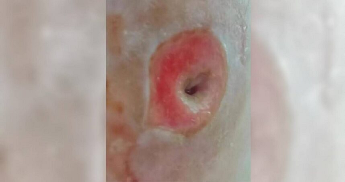 Người phụ nữ 40 tuổi chết lặng khi thấy mặt như "tổ ong" v&igrave; sai lầm ai cũng dễ mắc- Ảnh 1.