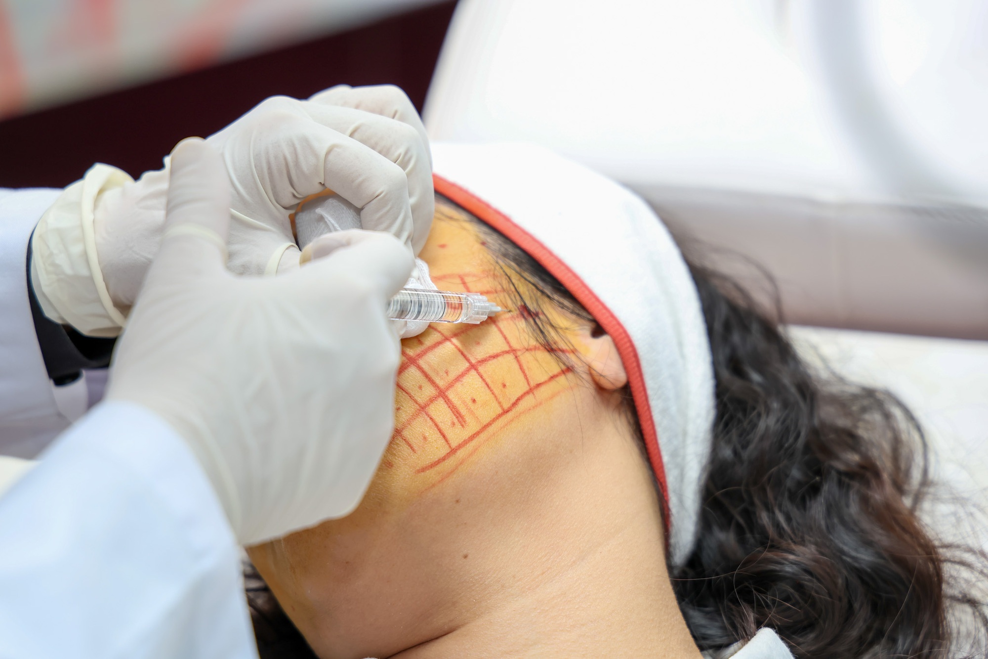 L&agrave;m đẹp bằng căng chỉ, c&ocirc; g&aacute;i nhập viện lấy dị vật - Ảnh 2.