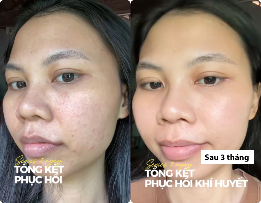 H&agrave;nh tr&igrave;nh dưỡng kh&iacute; huyết "cứu" da hư tổn của c&ocirc; n&agrave;ng tuổi 30: Từng &ldquo;toang&rdquo; v&igrave; peel da, giờ da dẻ hồng h&agrave;o, căng mịn, khỏe từ b&ecirc;n trong- Ảnh 4.