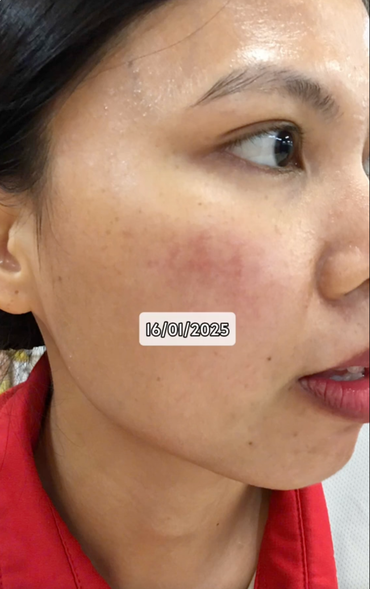 H&agrave;nh tr&igrave;nh dưỡng kh&iacute; huyết "cứu" da hư tổn của c&ocirc; n&agrave;ng tuổi 30: Từng &ldquo;toang&rdquo; v&igrave; peel da, giờ da dẻ hồng h&agrave;o, căng mịn, khỏe từ b&ecirc;n trong- Ảnh 3.