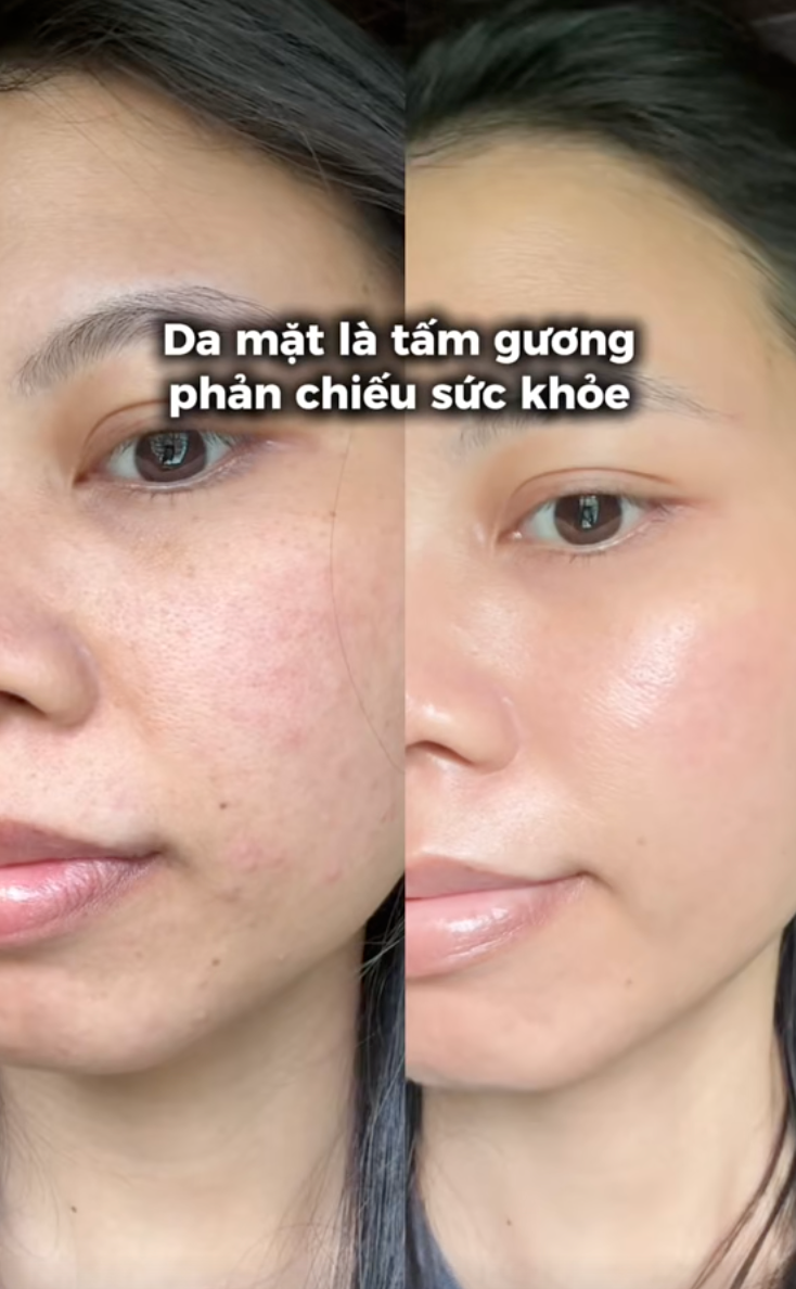 H&agrave;nh tr&igrave;nh dưỡng kh&iacute; huyết "cứu" da hư tổn của c&ocirc; n&agrave;ng tuổi 30: Từng &ldquo;toang&rdquo; v&igrave; peel da, giờ da dẻ hồng h&agrave;o, căng mịn, khỏe từ b&ecirc;n trong- Ảnh 16.