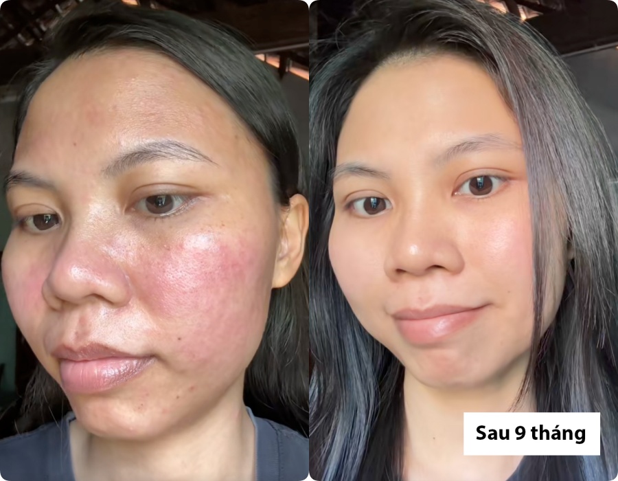 H&agrave;nh tr&igrave;nh dưỡng kh&iacute; huyết "cứu" da hư tổn của c&ocirc; n&agrave;ng tuổi 30: Từng &ldquo;toang&rdquo; v&igrave; peel da, giờ da dẻ hồng h&agrave;o, căng mịn, khỏe từ b&ecirc;n trong- Ảnh 5.