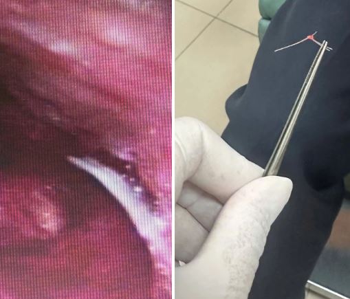 Đau họng sau khi ăn bánh mì, người phụ nữ 47 tuổi sốc nặng khi bác sĩ lấy ra thứ "đáng sợ" - áº¢nh 3.