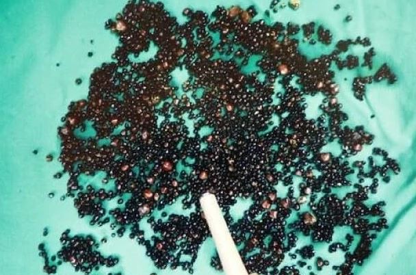 Đau bụng suốt nhiều th&aacute;ng, người đ&agrave;n &ocirc;ng 43 tuổi sốc nặng khi b&aacute;c sĩ gắp ra thứ "đ&aacute;ng sợ" trong bụng - Ảnh 1.
