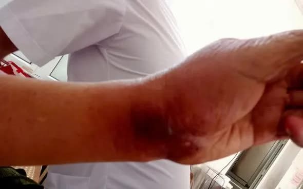 Cảnh b&aacute;o nguy cơ nhiễm tr&ugrave;ng, nhiễm độc nặng khi tiếp x&uacute;c với c&ocirc;n tr&ugrave;ng độc - Ảnh 1.
