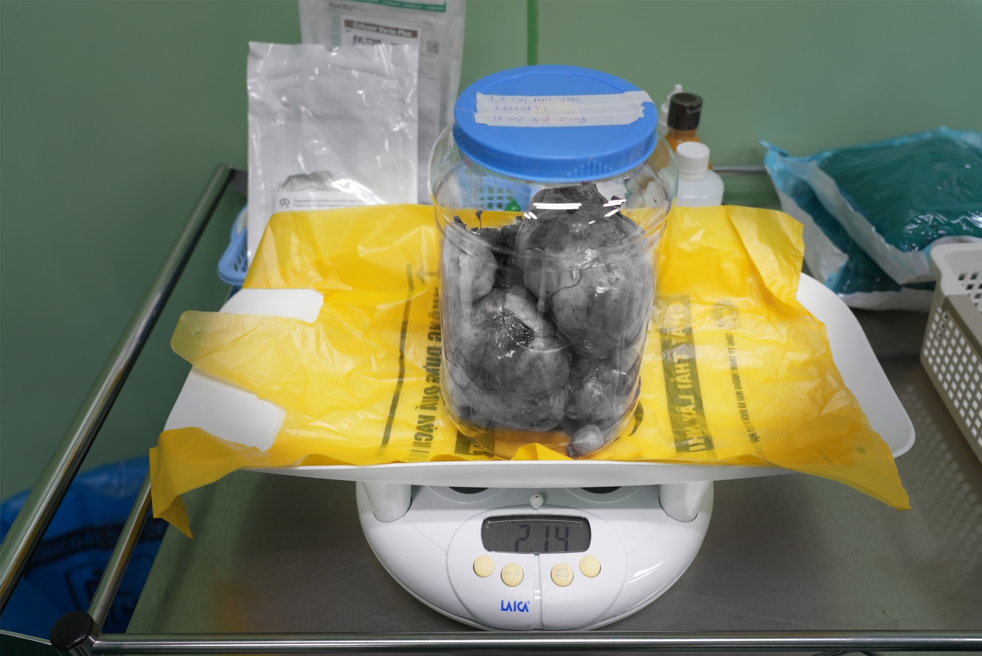Ca mổ lấy thai đặc biệt: Đ&oacute;n b&eacute; 3,3kg ch&agrave;o đời v&agrave; b&oacute;c t&aacute;ch th&agrave;nh c&ocirc;ng 9 khối u xơ tử cung - Ảnh 2.