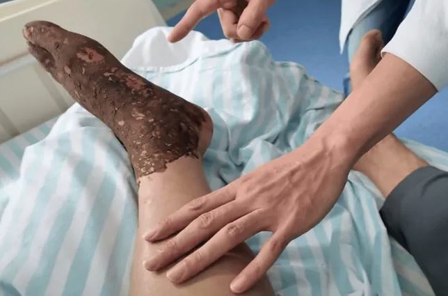 Bị rắn độc cắn khi đang cấy l&uacute;a, người đ&agrave;n &ocirc;ng l&agrave;m 1 việc khiến b&aacute;c sĩ khen ngợi - Ảnh 1.