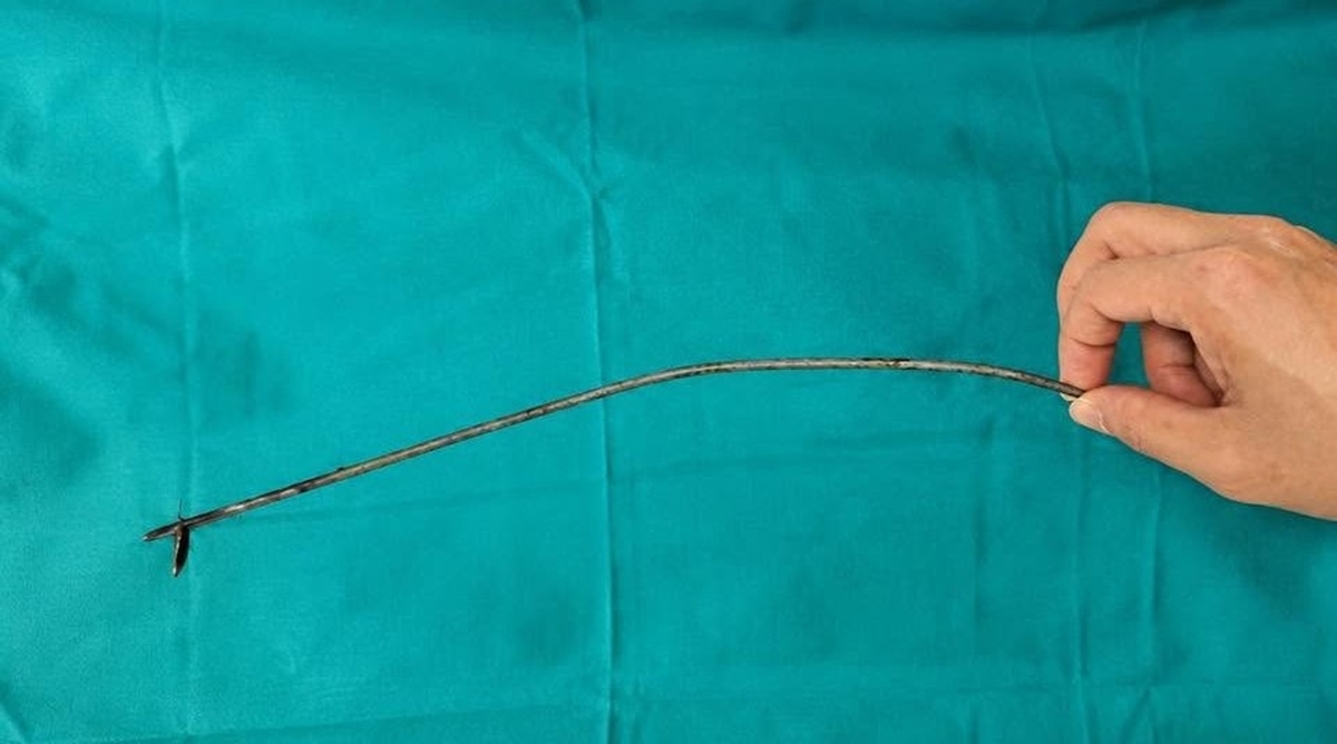 Nhập viện v&igrave; đau bất thường, nam bệnh nh&acirc;n 27 tuổi khiến b&aacute;c sĩ "sốc" khi lấy ra thứ kh&ocirc;ng ngờ tới - Ảnh 2.