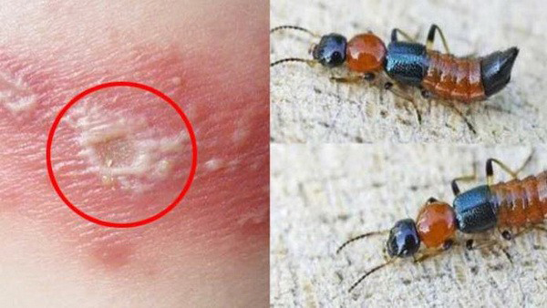 Những sai lầm phổ biến khi nhầm vi&ecirc;m da do kiến ba khoang với bệnh zona thần kinh - Ảnh 1.