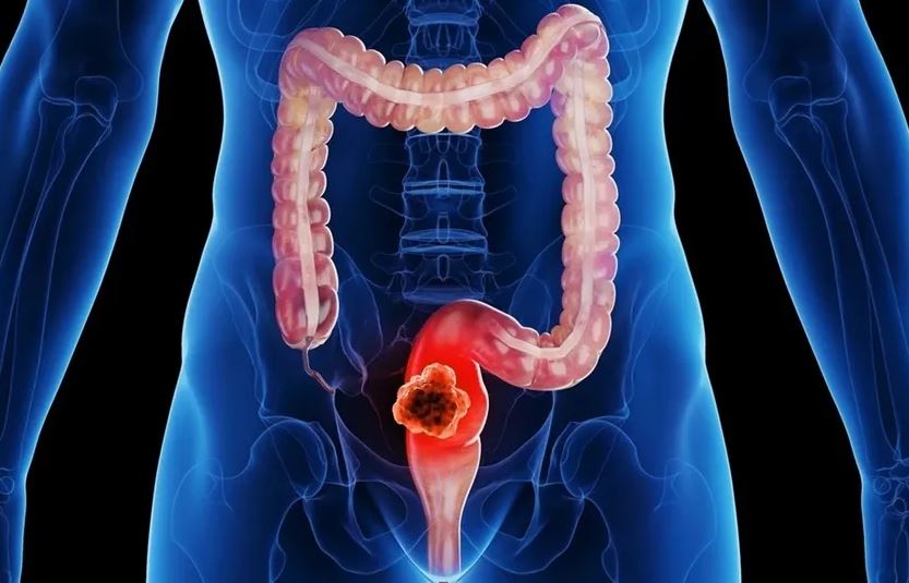 Người đ&agrave;n &ocirc;ng 45 tuổi tử vong sau khi sụt c&acirc;n, b&aacute;c sĩ chỉ r&otilde; 3 kiểu ăn s&aacute;ng "cực độc" - Ảnh 4.