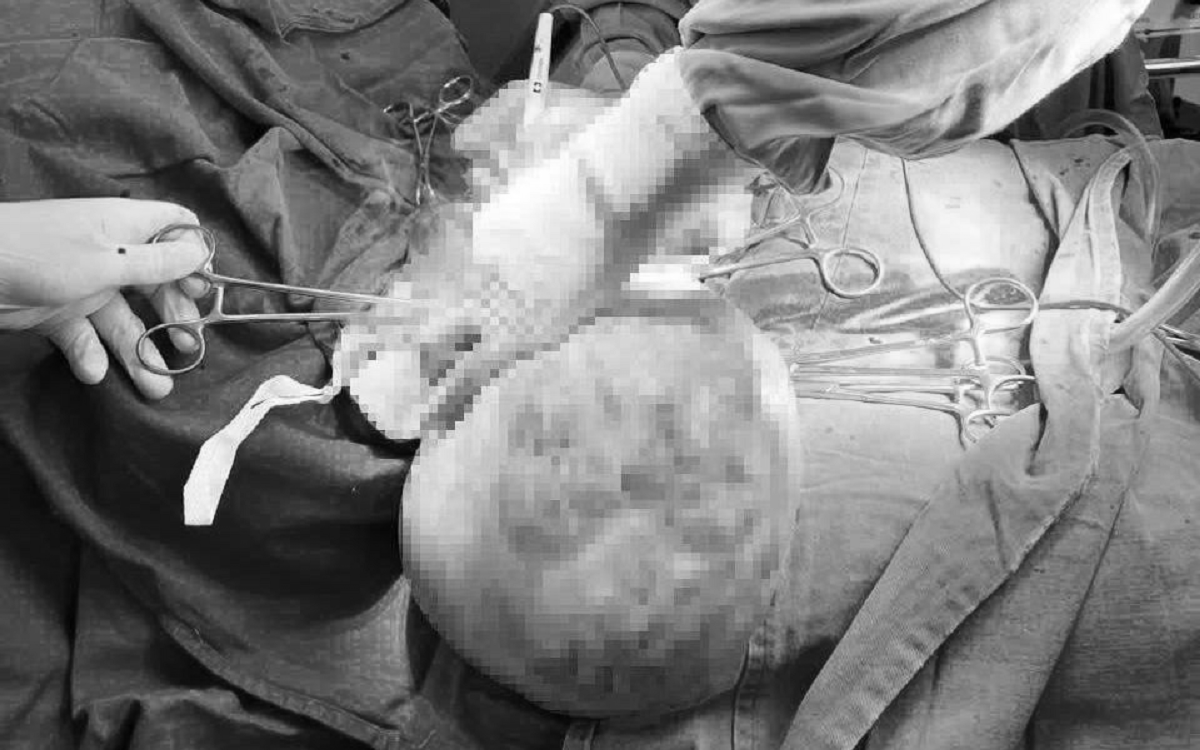 B&eacute; g&aacute;i 16 tuổi bụng to bất thường, bố mẹ sốc khi ph&aacute;t hiện b&iacute; mật "đ&aacute;ng sợ" b&ecirc;n trong - Ảnh 3.