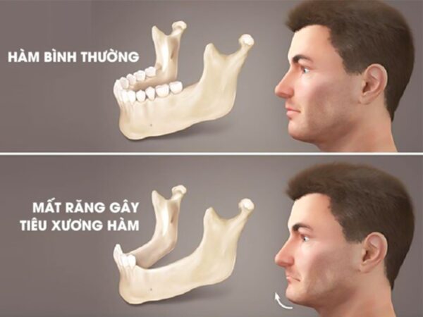 Đi kh&aacute;m răng định kỳ, thiếu nữ 17 tuổi t&igrave;nh cờ ph&aacute;t hiện "vật thể lạ" trong xương h&agrave;m v&agrave; căn bệnh di truyền nguy hiểm su&yacute;t bị bỏ qu&ecirc;n!- Ảnh 1.