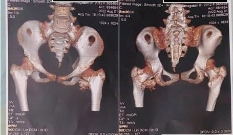 Xơ gan tuổi 31 do sử dụng đồ uống n&agrave;y mỗi ng&agrave;y: B&aacute;c sĩ cảnh b&aacute;o - Ảnh 2.