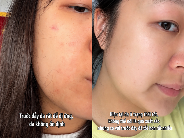Kh&ocirc;ng gi&uacute;p đẹp sau một đ&ecirc;m, nhưng th&oacute;i quen n&agrave;y khiến l&agrave;n da của t&ocirc;i ổn định hơn từng ng&agrave;y- Ảnh 2.