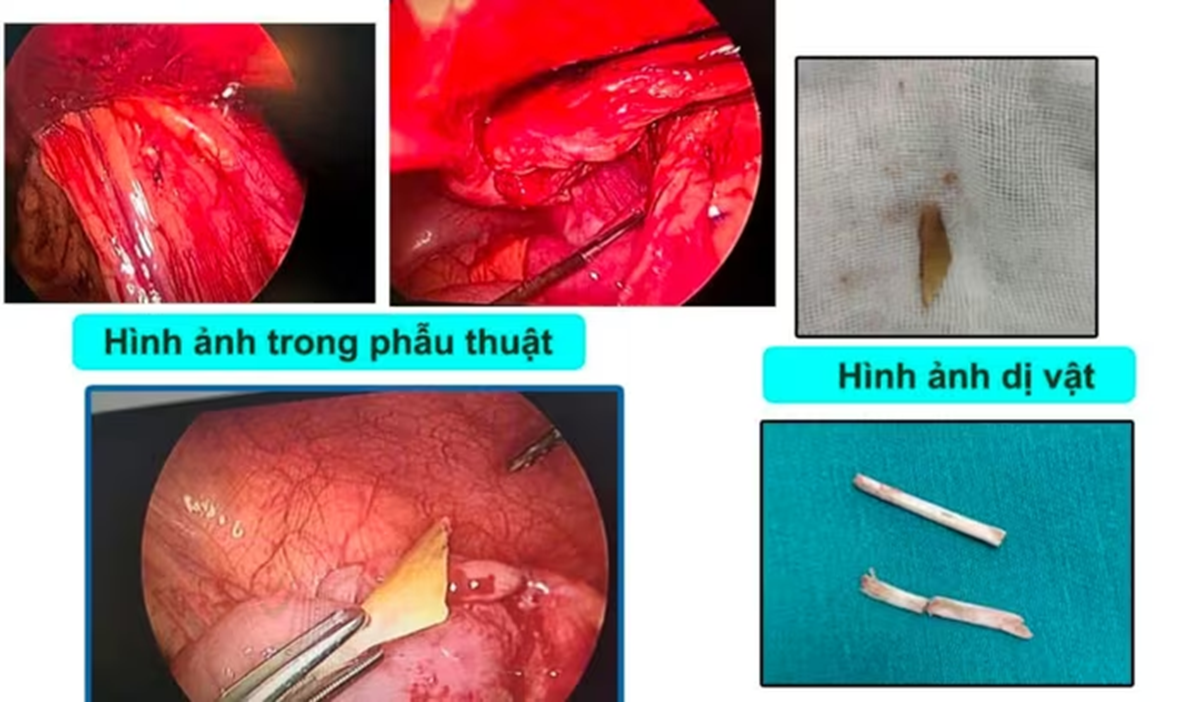 B&eacute; 4 tuổi đau bụng dữ dội, bố mẹ "sốc nặng" khi b&aacute;c sĩ lấy ra thứ kh&oacute; tin trong bụng - Ảnh 1.