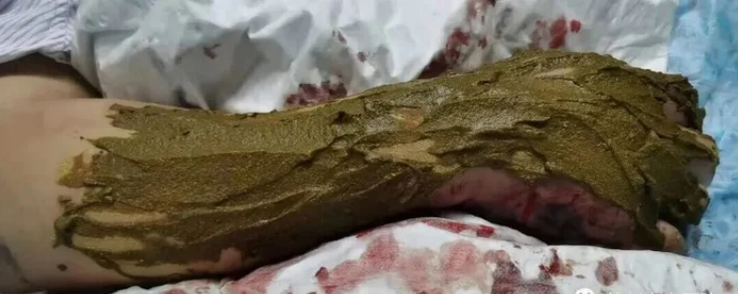 Rắn "cực độc" cắn người đ&agrave;n &ocirc;ng 55 tuổi, chuyện xảy ra sau đ&oacute; khiến ai cũng r&ugrave;ng m&igrave;nh - Ảnh 2.