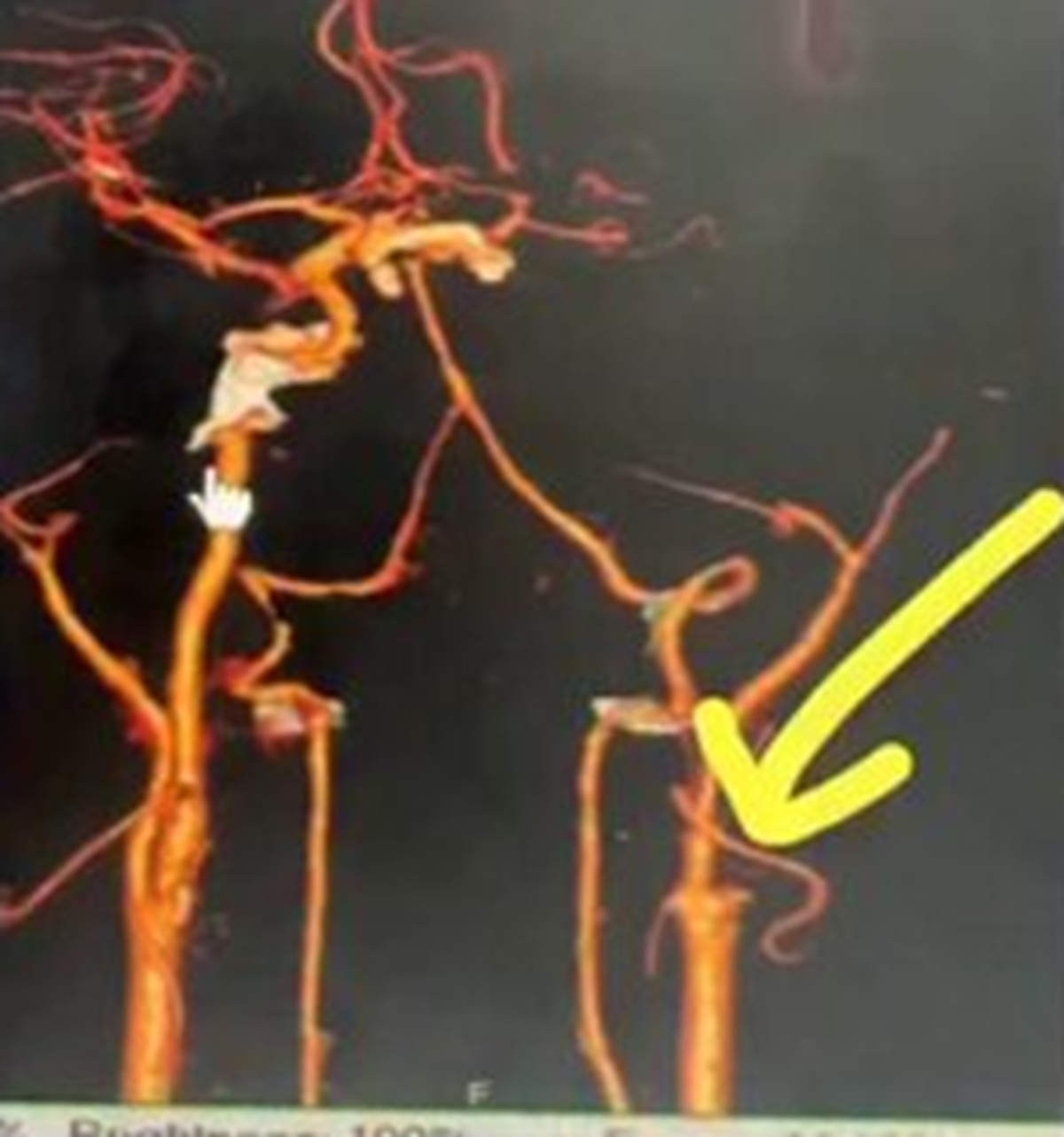 Được vợ m&aacute;t-xa v&igrave; đau cổ, người đ&agrave;n &ocirc;ng 54 tuổi chết n&atilde;o sau một đ&ecirc;m - Ảnh 2.