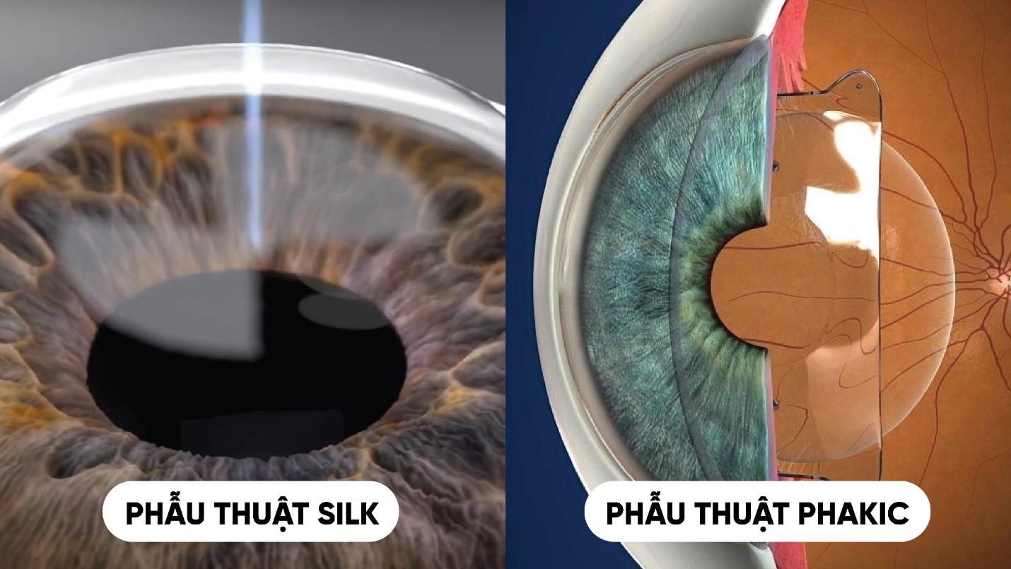 X&oacute;a cận m&ugrave;a h&egrave;: Đ&acirc;u l&agrave; lựa chọn ph&ugrave; hợp cho người trẻ năng động? - Ảnh 2.