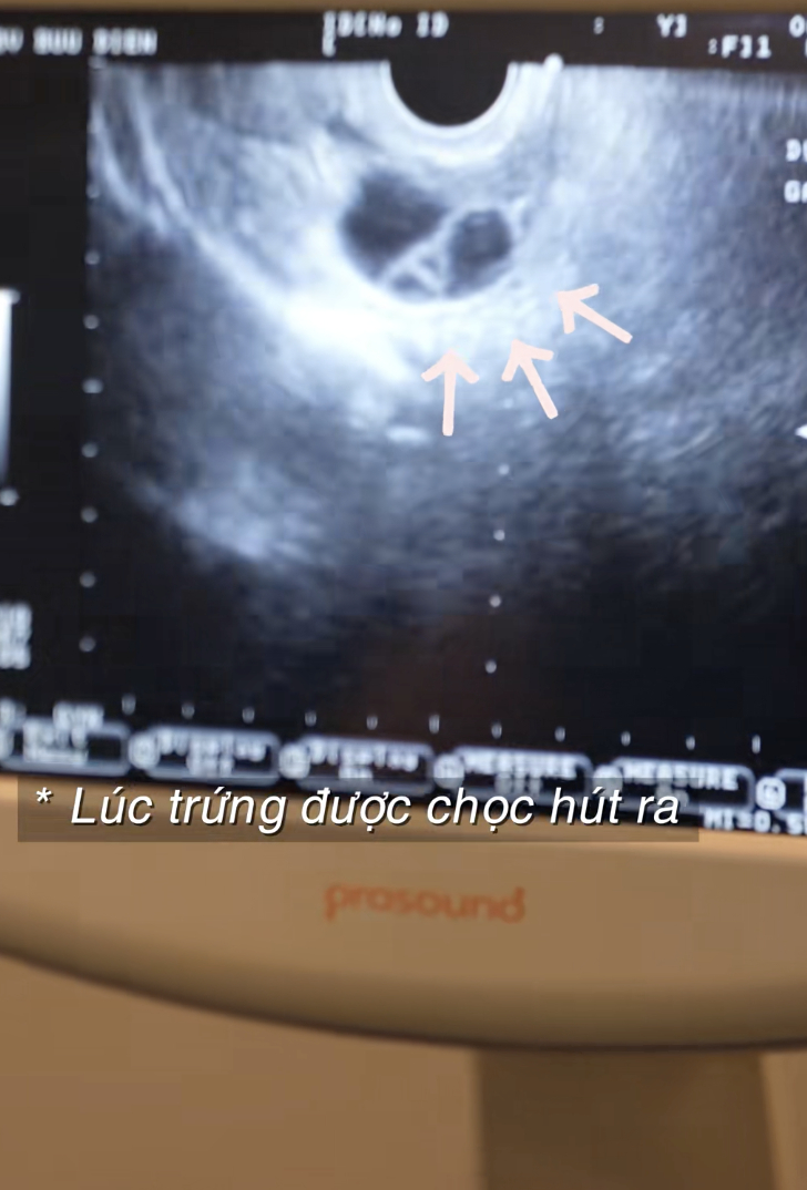 Chi 40 - 60 triệu trữ trứng: C&acirc;u chuyện của hai c&ocirc; g&aacute;i tuổi 30 c&oacute; kinh tế, đợi đ&uacute;ng người tinh tế- Ảnh 3.