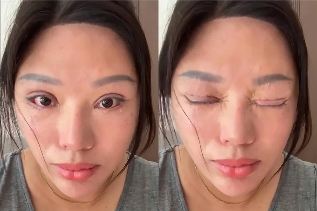 Người phụ nữ 6 năm kh&ocirc;ng thể nhắm mắt khi ngủ, l&yacute; do ph&iacute;a sau khiến nhiều người bất ngờ - Ảnh 1.