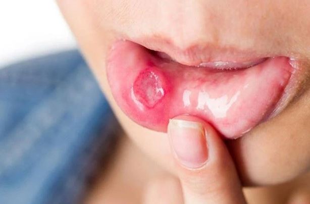 Người đ&agrave;n &ocirc;ng 53 tuổi c&oacute; dấu hiệu ung thư suốt 2 th&aacute;ng m&agrave; kh&ocirc;ng biết - Ảnh 2.