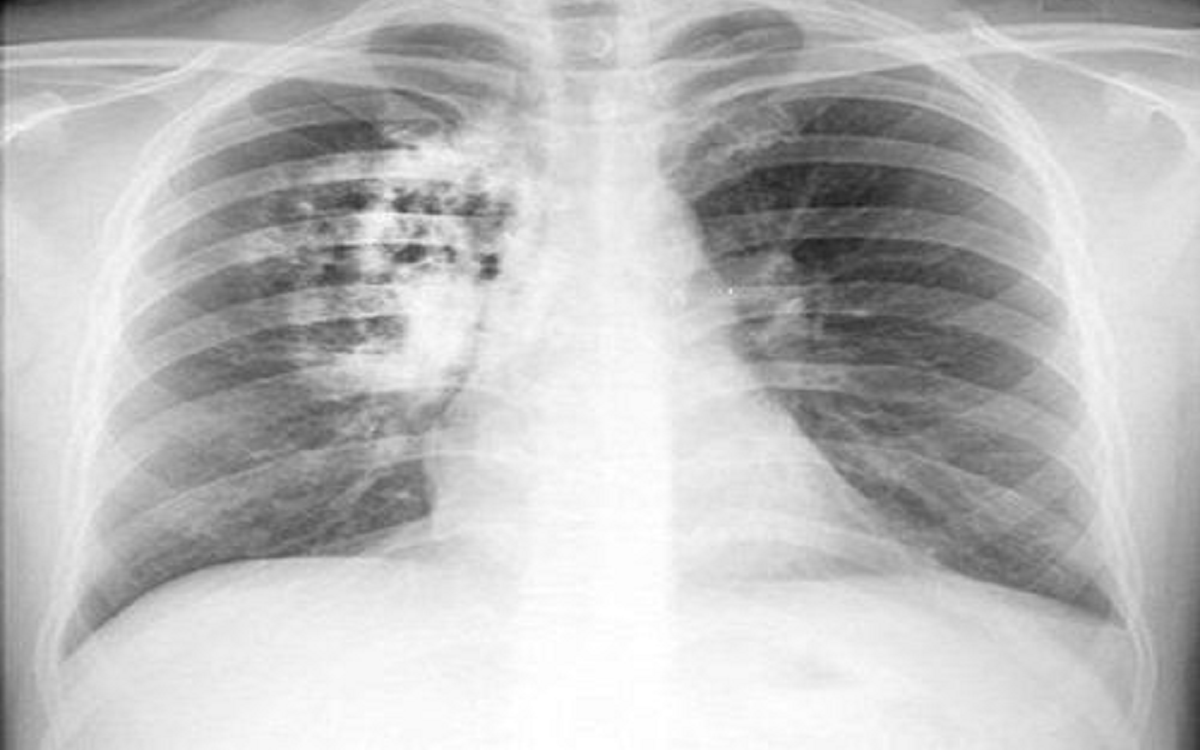 Người phụ nữ 27 tuổi "m&aacute;u trắng như sữa", b&aacute;c sĩ điểm mặt chỉ t&ecirc;n th&oacute;i quen ăn uống "cực độc" - Ảnh 2.
