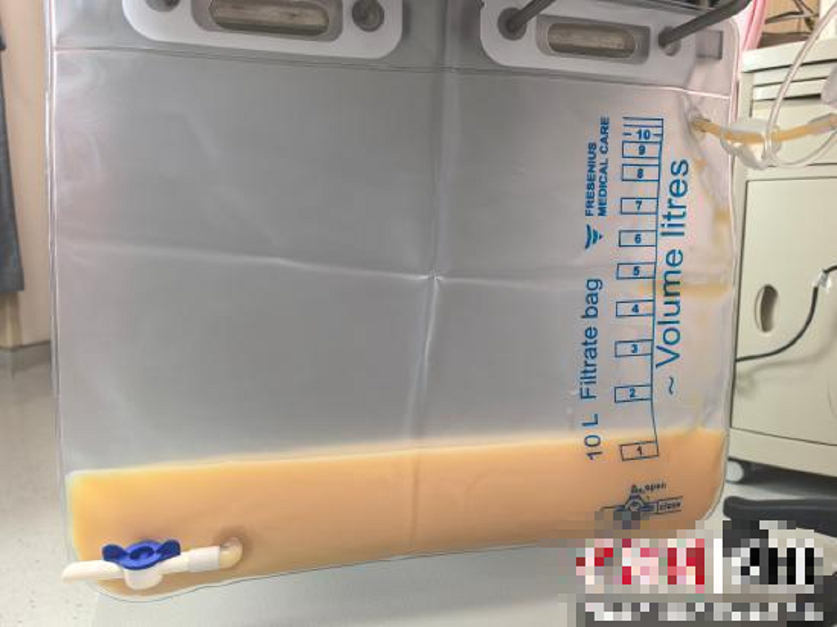 Người phụ nữ 45 tuổi "m&aacute;u trắng đục như sữa" v&igrave; uống thứ quen thuộc nhiều người m&ecirc; - Ảnh 1.