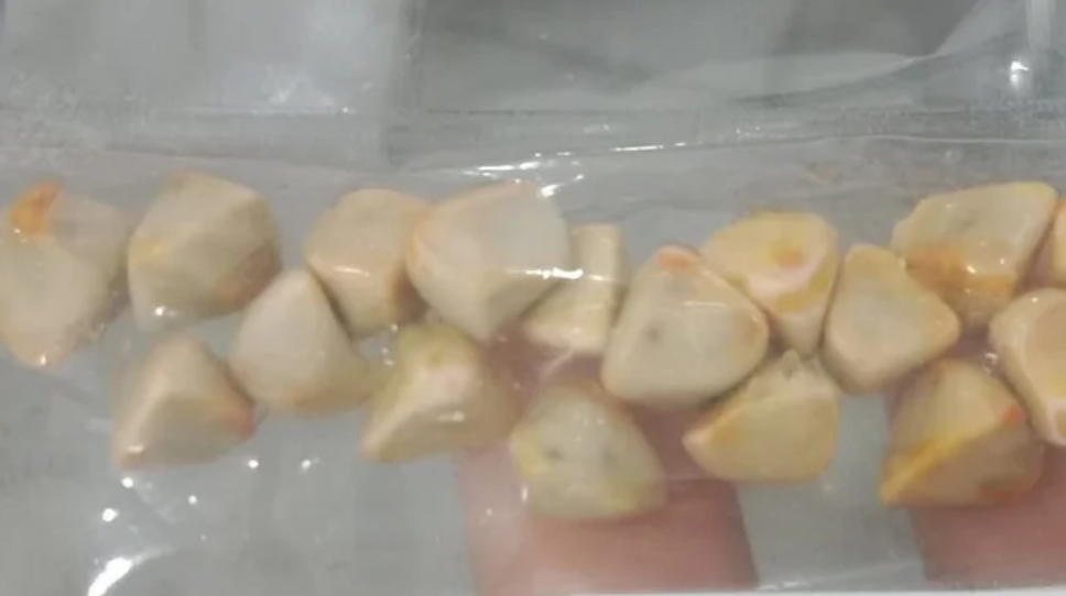 Uống tr&agrave; đ&aacute; đều đặn suốt 10 năm, người phụ nữ sốc khi b&aacute;c sĩ lấy ra thứ "đ&aacute;ng sợ" trong bụng- Ảnh 1.