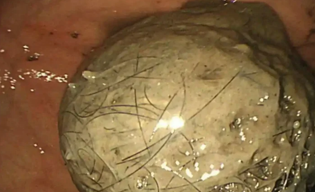 B&eacute; g&aacute;i 10 tuổi đau bụng suốt 3 năm, bố mẹ sốc khi b&aacute;c sĩ lấy ra thứ "đ&aacute;ng sợ" trong bụng- Ảnh 1.