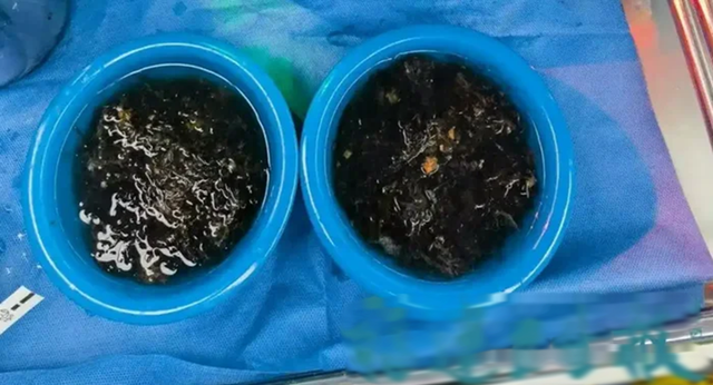 B&eacute; g&aacute;i 10 tuổi đau bụng suốt 3 năm, bố mẹ sốc khi b&aacute;c sĩ lấy ra thứ "đ&aacute;ng sợ" trong bụng- Ảnh 2.